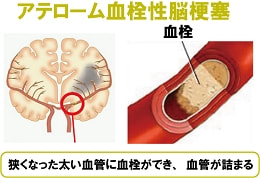 アテローム血栓性脳梗塞